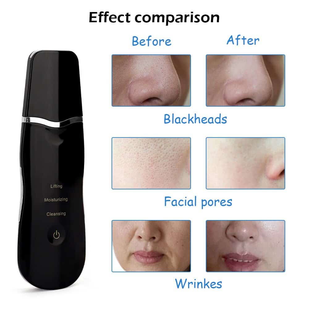 Ultrasonic Ion Facial Deep Cleaner Blackhead Acne Remover Facial Exfoliator Skin Scrubber Peeling Shovel Pore Cleaning Device